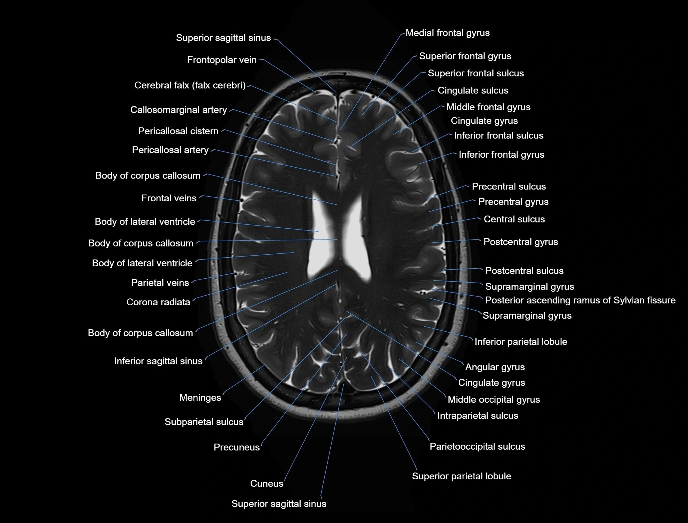 MRI Brain axial cross sectional radiology anatomy 3T image  -img-00001-00037.webp